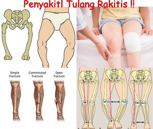 Kaki Rakhitis Penyakit tulang ( rakitis ) dapat dicegah dengan banyak mengonsum