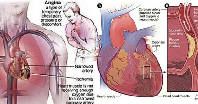 Apakah yang dimaksud dengan penyakit angin duduk?