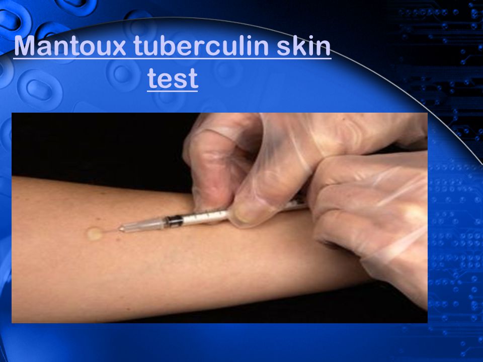 Mengenal Tes Mantoux Untuk Mendeteksi Tuberkulosis Pada Anak