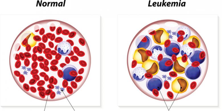 Pasien Leukemia Berhasil Disembuhkan dengan Rekayasa Genetik