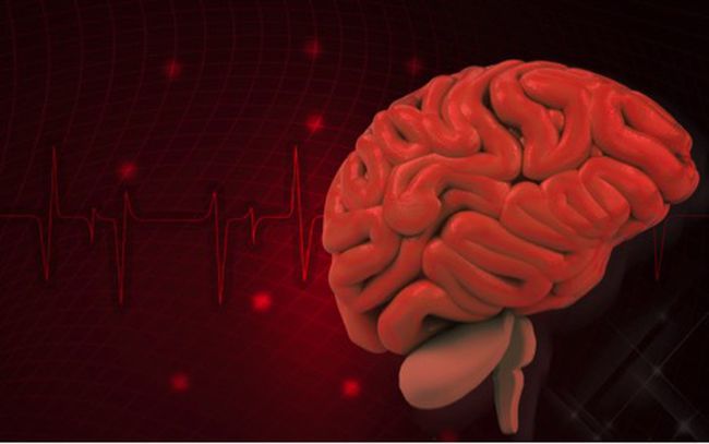 Mengenal Stroke, Akibat Sumbatan Pembuluh Darah di Otak