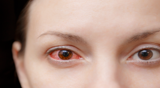 Mata Merah (Konjungtivitis) – Penyebab, Gejala, Diagnosis, Pengobatan & Pencegahan