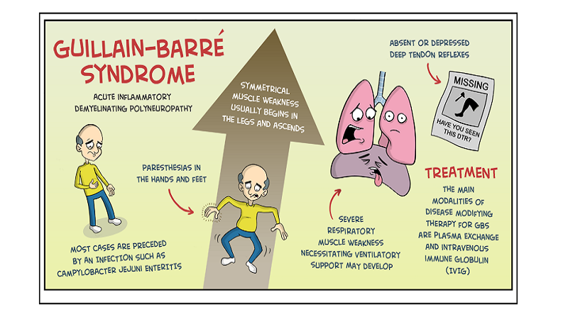 Penyakit Guillain Barre Syndrome: Kenali Gejala hingga Pengobatannya di Sini!