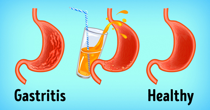 Pengertian Mag Gastritis  Penyebab  Gejala dan Cara 