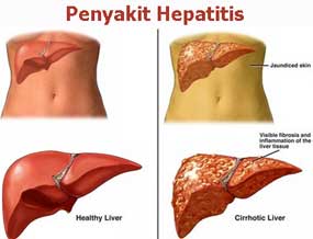 Penyakit Hepatitis, Gejala, Diagnosa dan Cara Mengobatinya
