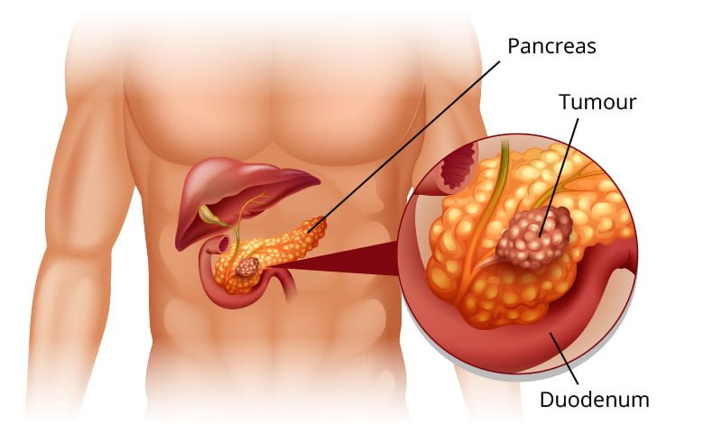 Mengenal Penyakit Kanker Pankreas 