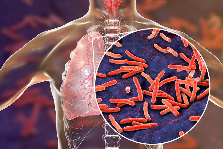 Bagaimana Cara Penularan Bakteri TBC?